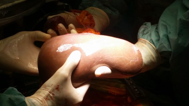 Transplantacija jetre izvodi se kada su iscrpljene sve ostale moguænosti leèenja